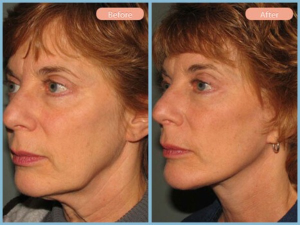 Before and After Image: Facelift - left-front-oblique
