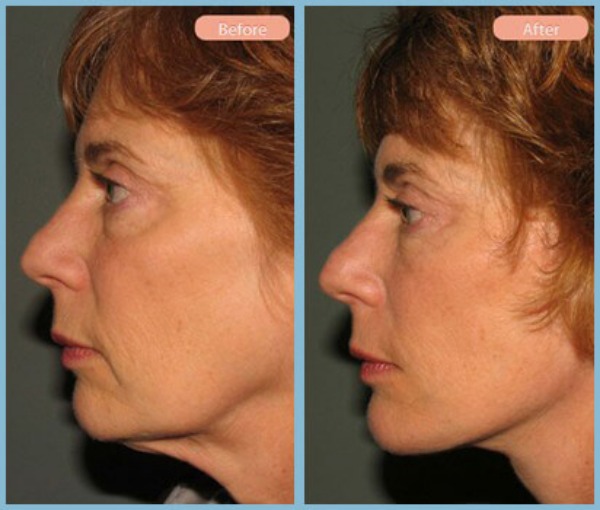 Before and After Image: Facelift - left-side