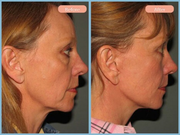 Before and After Image: Facelift and Lower Eyelid Blepharoplasty - right-side