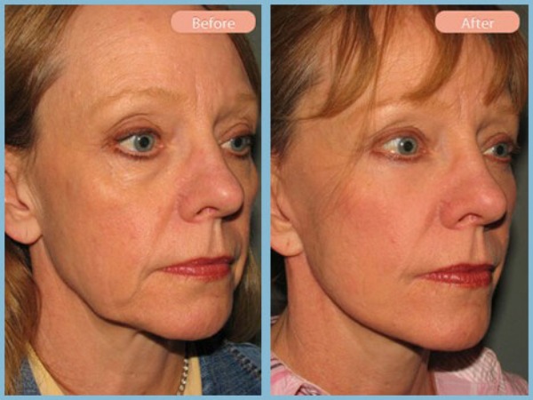 Before and After Image: Facelift and Lower Eyelid Blepharoplasty - right-front-oblique