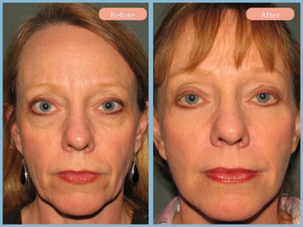 Before and After Image: Facelift and Lower Eyelid Blepharoplasty - front