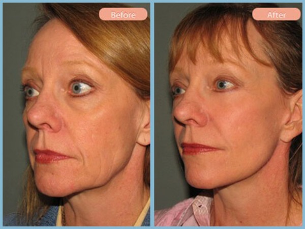 Before and After Image: Facelift and Lower Eyelid Blepharoplasty - left-front-oblique