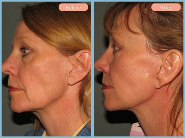 Before and After Image: Facelift and Lower Eyelid Blepharoplasty - left-side