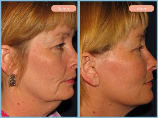 Before and After Image: Facelift, Neck Liposuction, and Upper Eyelid Blepharoplasty - right-side