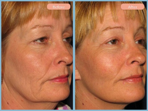 Before and After Image: Facelift, Neck Liposuction, and Upper Eyelid Blepharoplasty - right-front-oblique