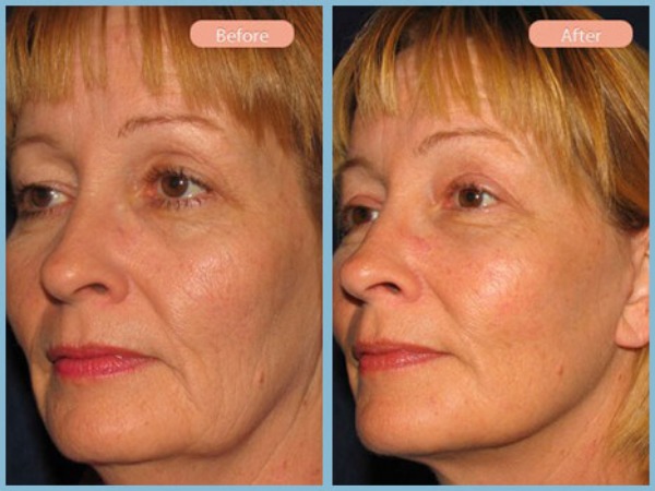 Before and After Image: Facelift, Neck Liposuction, and Upper Eyelid Blepharoplasty - left-front-oblique