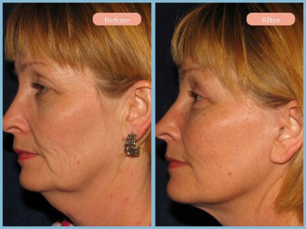 Before and After Image: Facelift, Neck Liposuction, and Upper Eyelid Blepharoplasty - left-side