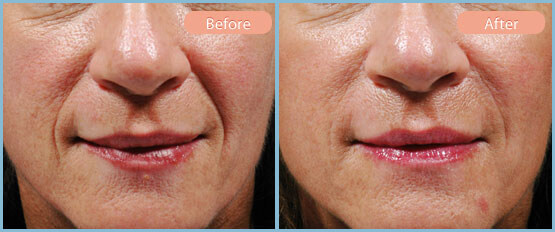 Before and After Image: Restylane, Juvederm, Radiesse - front