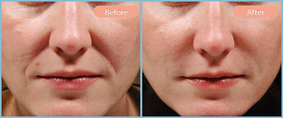 Before and After Image: Restylane, Juvederm, Radiesse - front