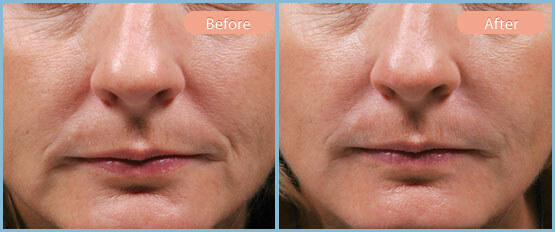 Before and After Image: Restylane, Juvederm, Radiesse - front