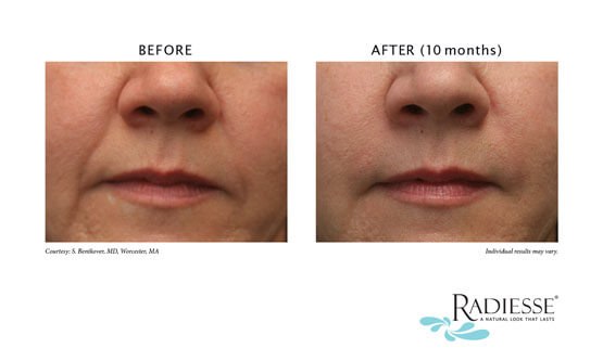 Before and After Image: Restylane, Juvederm, Radiesse - front