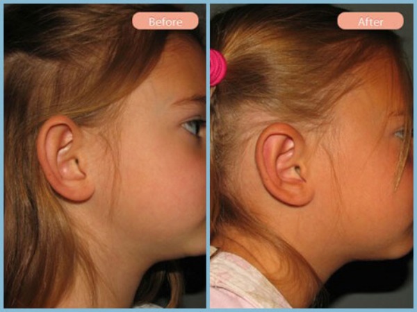 Before and After Image: Otoplasty