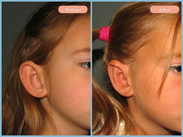 Before and After Image: Otoplasty - right-front-oblique