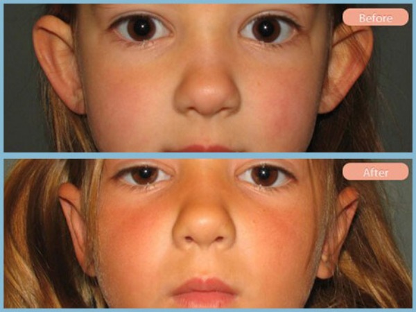 Before and After Image: Otoplasty - front