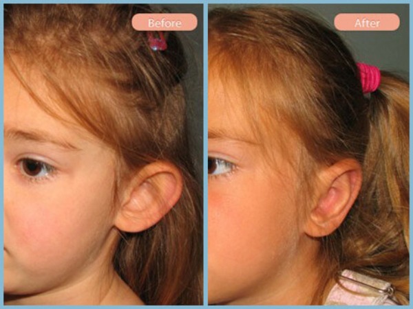 Before and After Image: Otoplasty - left-front-oblique