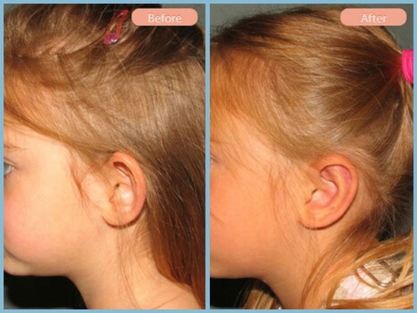 Before and After Image: Otoplasty - left-side