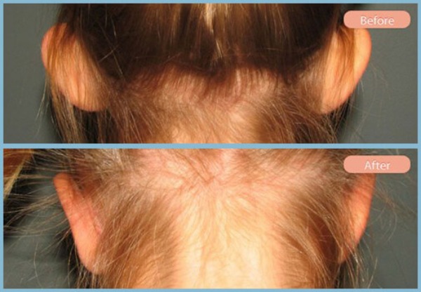 Before and After Image: Otoplasty - back