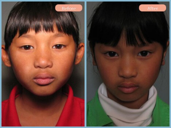 Before and After Image: Otoplasty - front