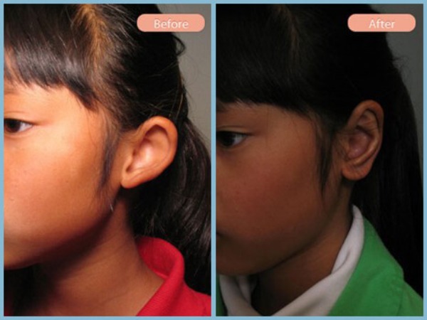Before and After Image: Otoplasty - left-front-oblique