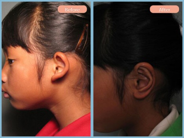 Before and After Image: Otoplasty - left-side