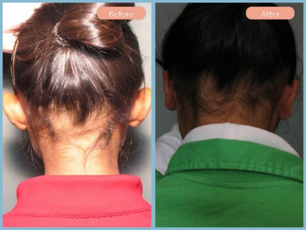Before and After Image: Otoplasty - back