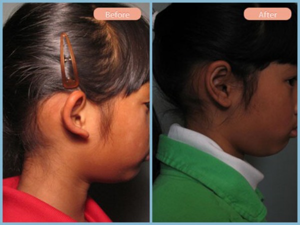 Before and After Image: Otoplasty - right-side