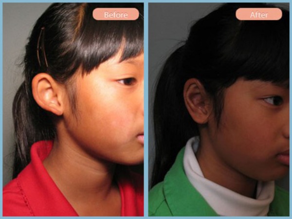 Before and After Image: Otoplasty - right-front-oblique