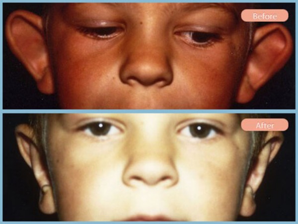 Before and After Image: Otoplasty