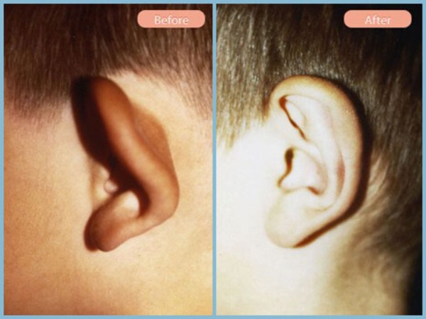 Before and After Image: Otoplasty - left-side