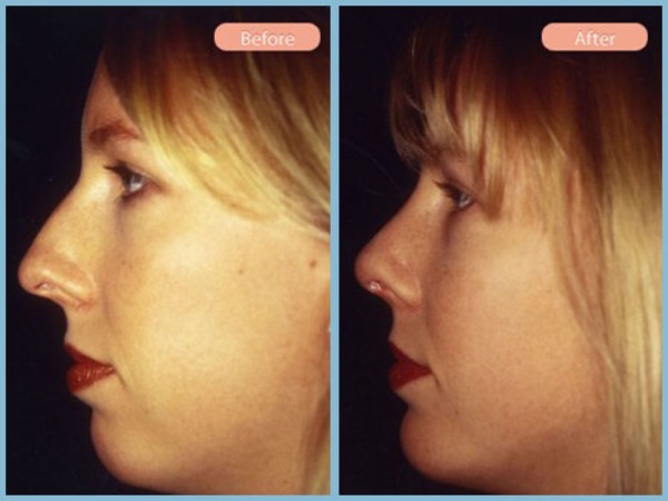 Before and After Image: Rhinoplasty and Chin Enhancement