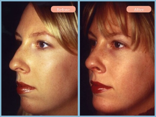 Before and After Image: Rhinoplasty and Chin Enhancement - left-front-oblique