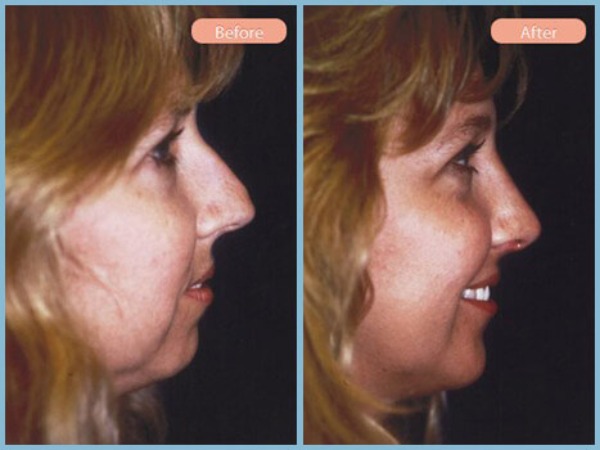 Before and After Image: Rhinoplasty and Chin Enhancement - right-side