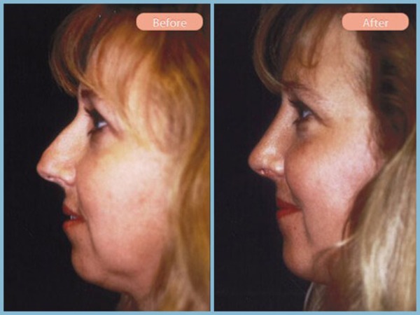 Before and After Image: Rhinoplasty and Chin Enhancement - left-side