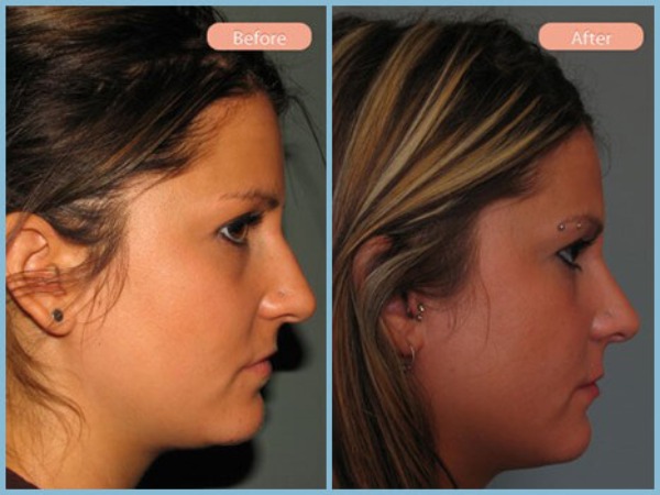 Before and After Image: Rhinoplasty