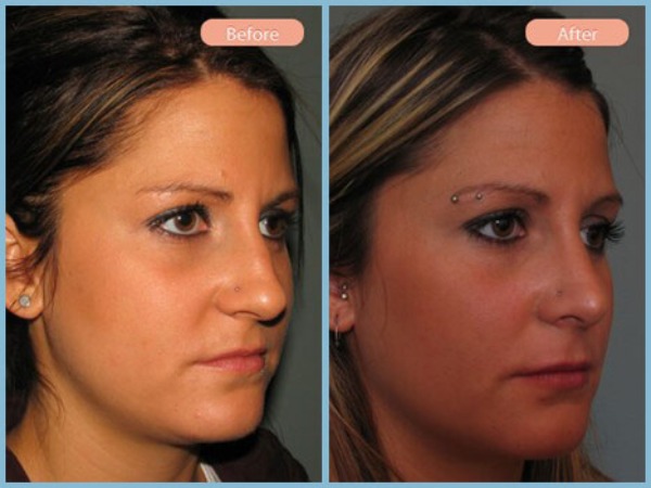 Before and After Image: Rhinoplasty - right-front-oblique