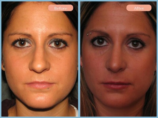 Before and After Image: Rhinoplasty - front