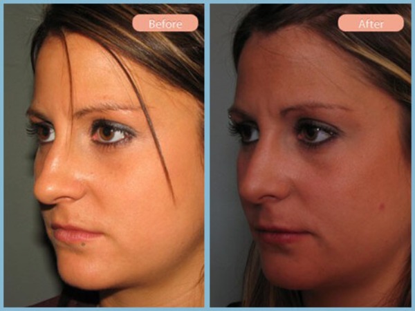 Before and After Image: Rhinoplasty - left-front-oblique
