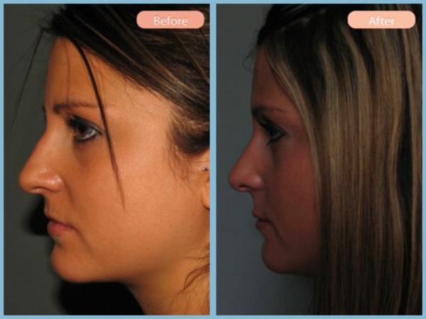 Before and After Image: Rhinoplasty - left-side