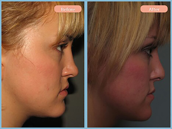 Before and After Image: Rhinoplasty