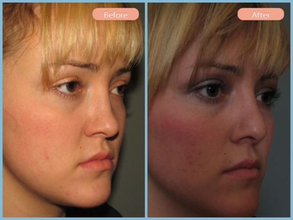 Before and After Image: Rhinoplasty - right-front-oblique