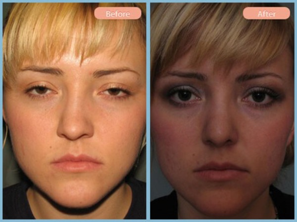 Before and After Image: Rhinoplasty -