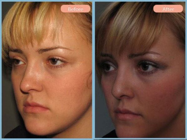Before and After Image: Rhinoplasty - left-front-oblique