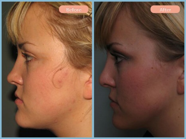Before and After Image: Rhinoplasty - left-side