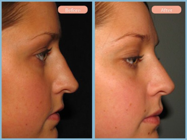 Before and After Image: Rhinoplasty - right-side
