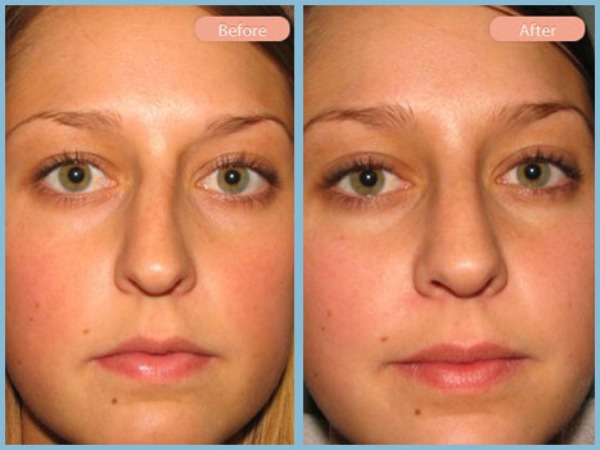 Before and After Image: Rhinoplasty - front