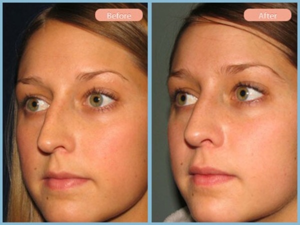 Before and After Image: Rhinoplasty - left-front-oblique