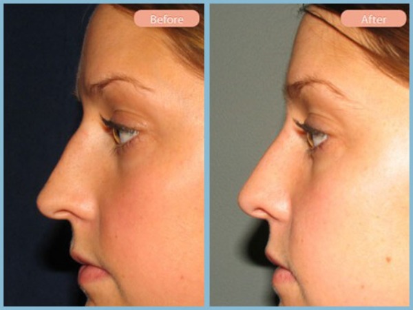 Before and After Image: Rhinoplasty - left-side