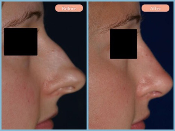 Before and After Image: Rhinoplasty - right-side
