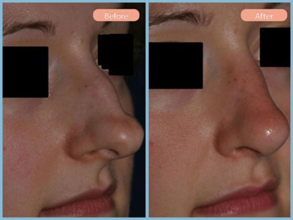 Before and After Image: Rhinoplasty - right-front-oblique
