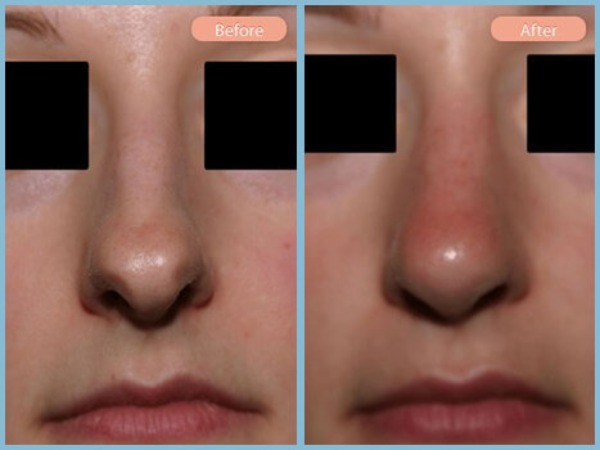 Before and After Image: Rhinoplasty - front